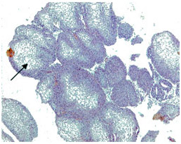 Плоскоклеточная метаплазия с участками кератинизации (лейкоплакия мочевого пузыря). Увеличение х 200, окраска гематоксилин-эозином.