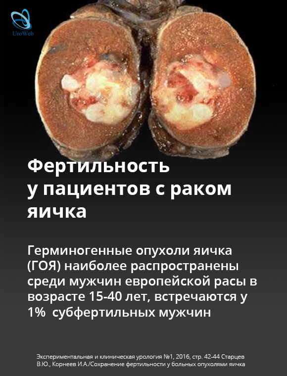 Фертильность у пациентов с раком яичка