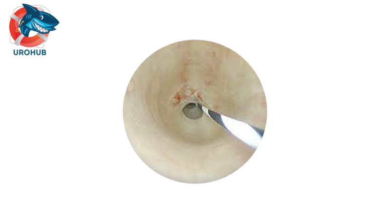 Гольмиевый лазер в сравнении с визуальной внутренней уретротомией холодным ножом при лечении стриктуры короткого сегмента уретры: проспективное рандомизированное клиническое исследование