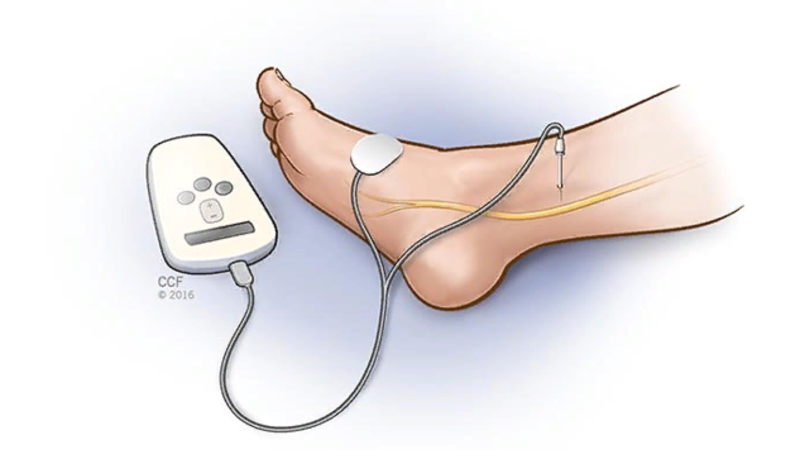 чрескожная электростимуляция зрительного нерва. электростимуляция малоберцового нерва при нейропатии. электростимулятор глаз аппарат. электростимулятор лучевого нерва. электротерапия электрофорез.