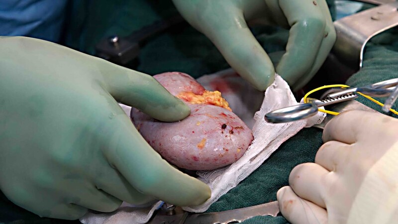 Раннее удаление мочеточникового стента после трансплантации почки снижает частоту инфекции мочевых путей