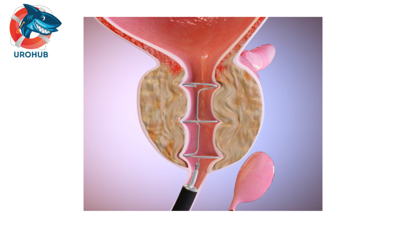 12-месячные результаты первого исследования системы Zenflow для лечения ДГПЖ