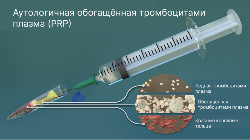 Краткий обзор по аутологичной тромбоцитарной плазме (PRP) при эректильной дисфункции (ЭД) 2025 г.