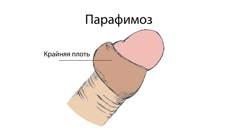 Парафимоз: клинический обзор для практикующих урологов