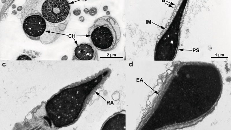 Акросомы в форме пузырька (“bubble-shaped”) являются новым фенотипом акросомальной аномалии