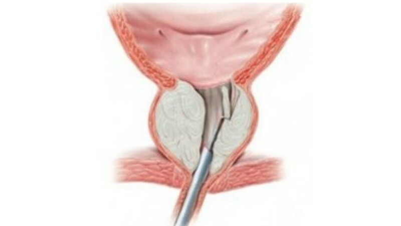 Эмболизация артерий предстательной железы в сравнении с трансуретральной резекцией предстательной железы при лечении ДГПЖ