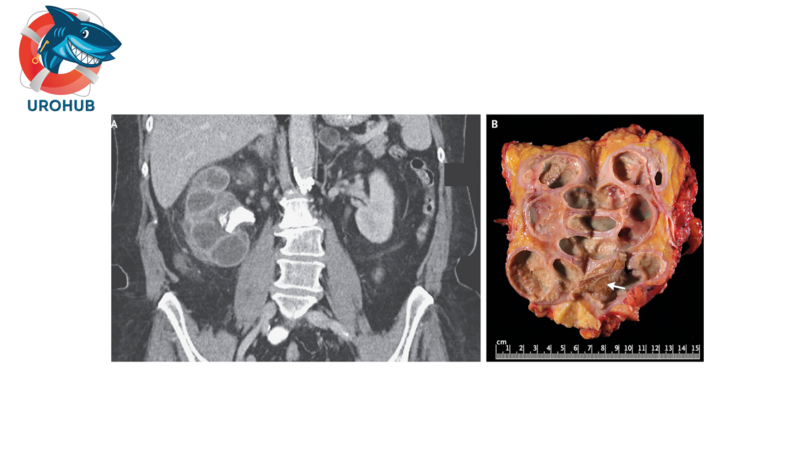 Ксантогранулематозный пиелонефрит: систематический обзор терапии и смертности