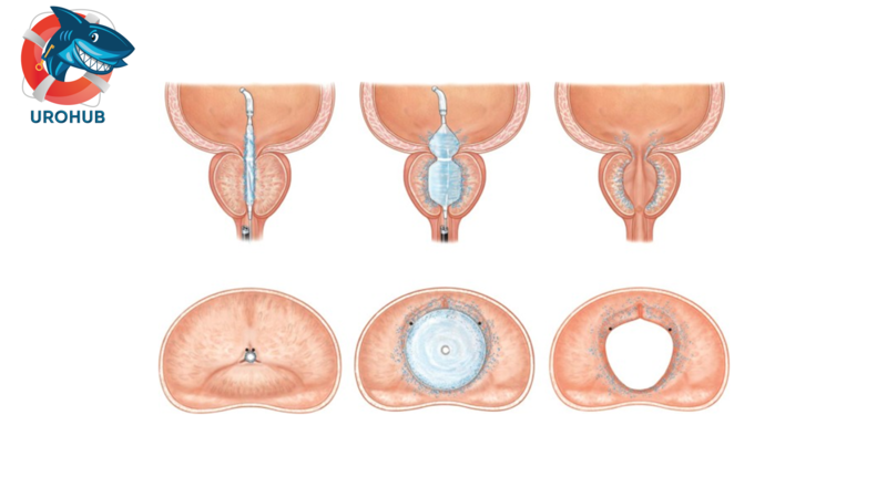 Исследование PINNACLE: двойное слепое рандомизированное контролируемое исследование по оценке катетерной системы Optilume BPH для лечения СНМП/ДГПЖ