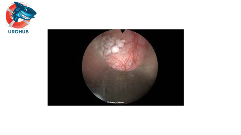 Отдаленные результаты электрофульгурации при антибиотико-резистентных рецидивирующих инфекциях мочевых путей
