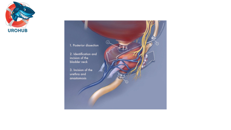 Изменение общенациональных тенденций отказа от чрезмерного лечения среди пациентов, перенесших радикальную простатэктомию за последние 25 лет