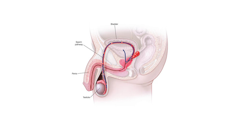 Анэякуляция и ретроградная эякуляция - обзор причин, методов диагностики и лечения