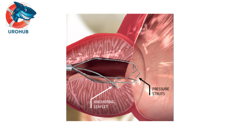Минимально инвазивные методы лечения ДГПЖ: систематический обзор и метаанализ