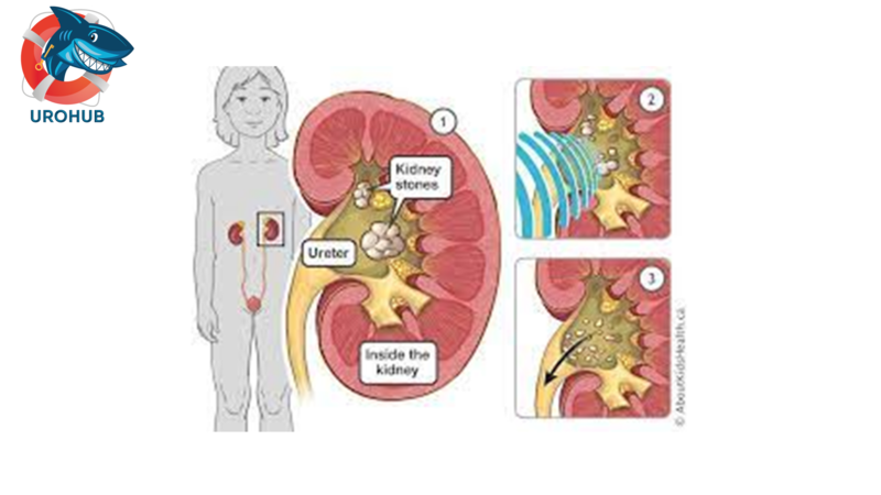 Эффективность ЭУВЛ при лечении камней в почках и мочеточниках у детей