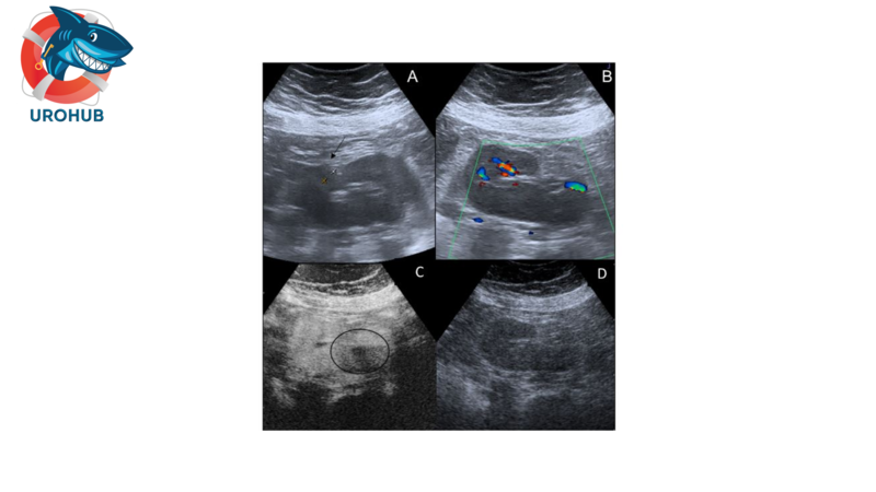 Острый пиелонефрит: роль ультразвукового исследования с контрастным усилением (CEUS)