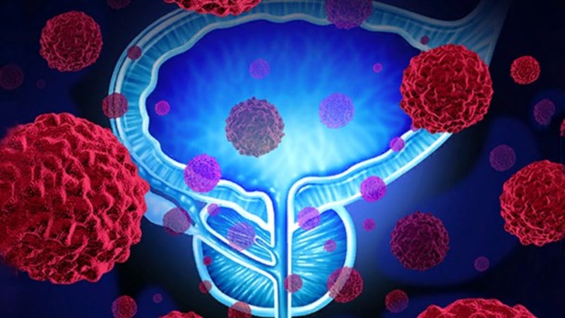 Прием ингибиторов 5α-редуктазы связан с поздней постановкой диагноза рака предстательной железы