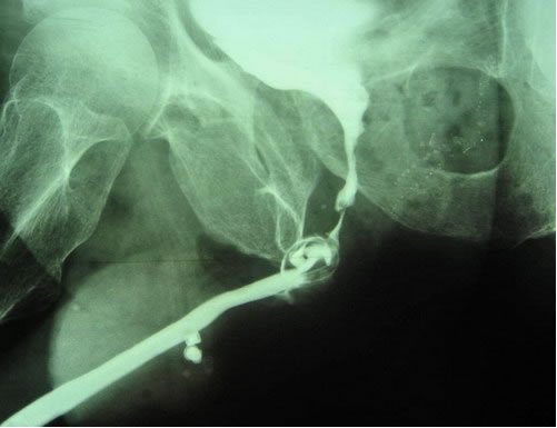 Сфинктеры и слинговые операции при недержании мочи у мужчин