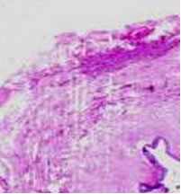 Второй тип: соединительной ткани по периметру мочеточника, он занимает от 26 до 75% величины периметра.