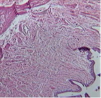 Третий тип: соединительная ткань занимает более 75% длины периметра мочеточника.