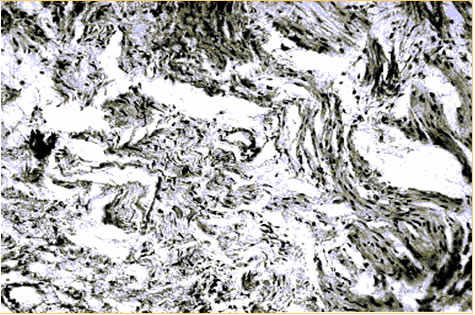 14 сутки (Неполный сетчатый (перимускулярный) склероз)