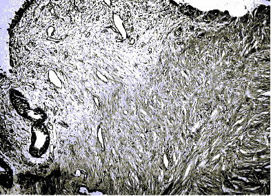 41 сутки (Склероз подслизистого, очаговая гиперплазия уротелия с фокусами плоскоклеточной метаплазии)