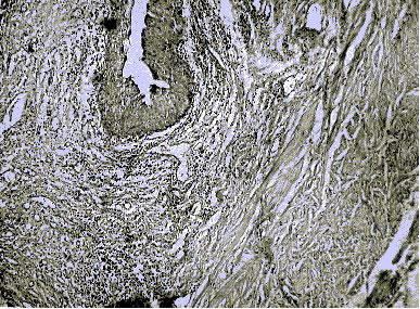 459 сутки (Выраженный склероз всех слоев мочеточника)