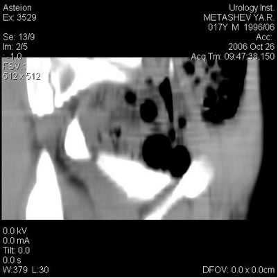 Компьютерная томография - Нейромышечная дисплазия мочеточников: ахалазия