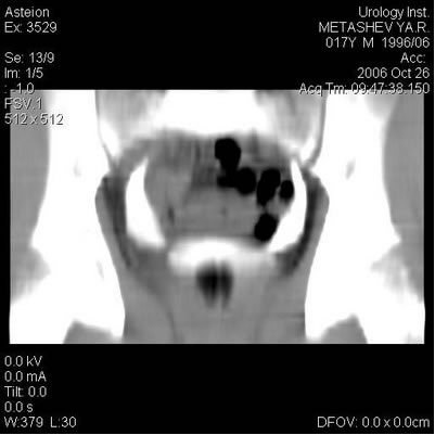 Компьютерная томография - Нейромышечная дисплазия мочеточников: ахалазия