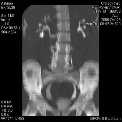 Компьютерная томография - Нейромышечная дисплазия мочеточников: ахалазия