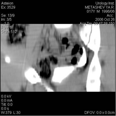Компьютерная томография - Нейромышечная дисплазия мочеточников: ахалазия