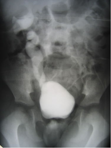 рецидив ПМР IV степени справа и стриктура н/3 левого мочеточника
