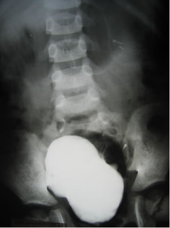 Цистография