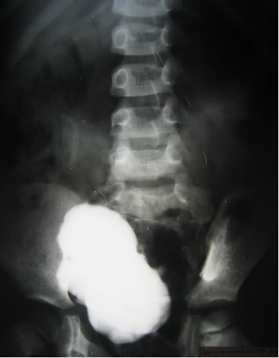 Цистография