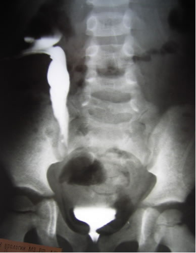 Антеградная уретерография справа