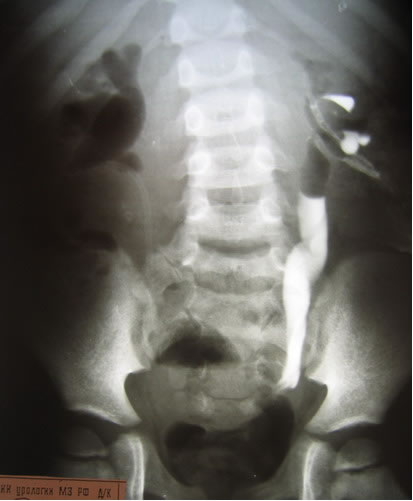 Антеградная уретерография слева