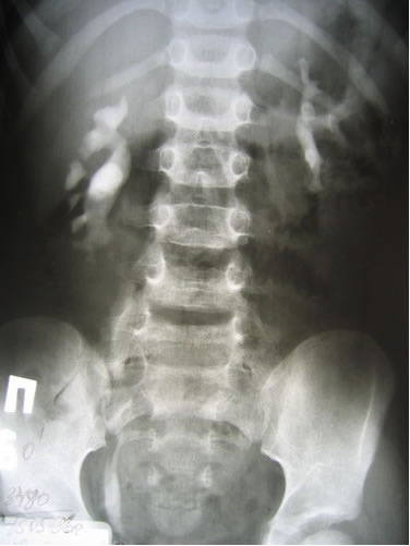 Обзорная и экскреторная урография