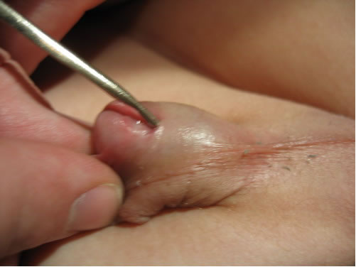 Гипоспадия, стволовая форма