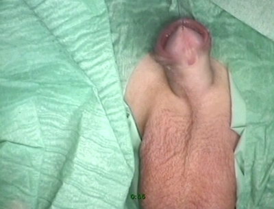 Уретрадағы пениса бейне Уретрадағы пениса бейне