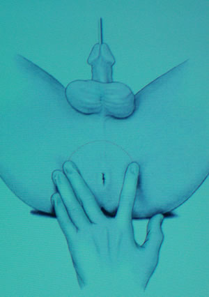 Доступ к простате при радикальной промежностной простатэктомии.