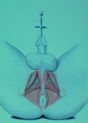 В уретру проведен специальный металлический инструмент, который будет служить ориентиром при выделении уретры и простаты во время операции.