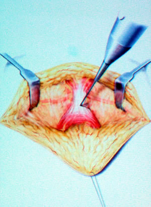 Рассечение связки соединяющей мышцы ануса и бульбозного отдела уретры.