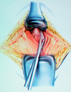 Выделение простаты, разъединение мышц тазового дна.