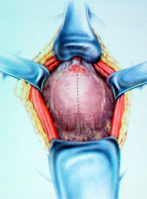 Выделена простата, пунктиром намечены дальнейшие разрезы для выделения простаты.