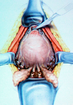 Сосуды простаты обработаны, рассекается задняя стенка уретра у апикальной части простаты, в уретре расположен специальный металлический инструмент, помогающий визуализировать уретру, простату.