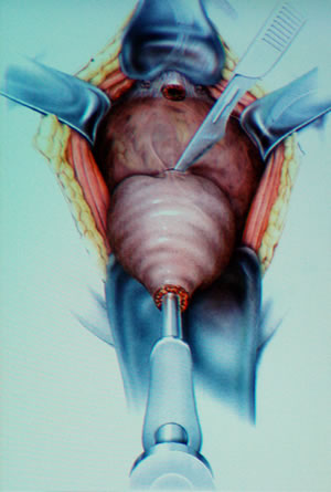 Простаты выделена полностью (сохраняется связь с семенными пузырьками), сосудистые пучки обработаны, идет отсечение простаты от шейки мочевого пузыря (рассечена передняя поверхность стенки шейки мочевого пузыря).