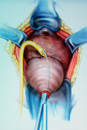 В отсеченную простатическую уретру вводится катетер Фолея, что бы оператор смог удобно удерживать простату на пропущенном сквозь нее катетер.