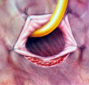 Идет этап подготовки шейки мочевого пузыря для наложения его анастомоза с дистальной уретрой при радикальной промежностной простатэктомии. Слизистая мочевого пузыря адаптируется эвертированными швами к шейке мочевого пузыря, что бы в последующем наложить четкий, фактически «водонепроницаемый» слизисто-мышечный анастомоз.