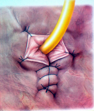 Идет этап подготовки шейки мочевого пузыря для наложения его анастомоза с дистальной уретрой при радикальной промежностной простатэктомии. Широко раскрытая шейка мочевого пузыря уменьшается до размеров достаточных для адекватного анастомоза, что бы размер уретры и новой шейки мочевого пузыря были сопоставимы по диаметру.