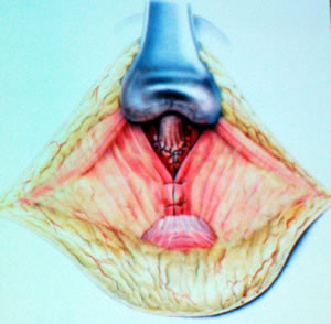 Сформированный анастомоз, ушивается мышцы тазового дна. В рану ставится дренаж, рана ушивается послойно.