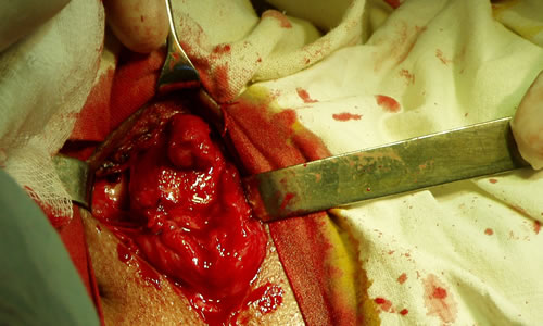 Уретра отсечена, видна культя отсеченной уретры