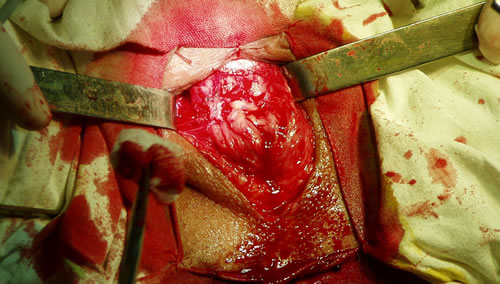 Культя дистального конца отсеченной уретры временно заведена под верхний угол раны, фиксирована марлевым шариком